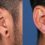 Reconstruction of the ear